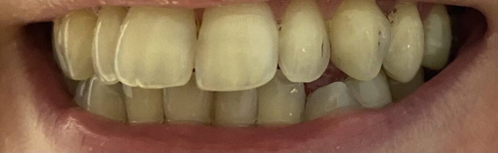 美白牙齒噴砂完2個月牙齒出現一點斑點